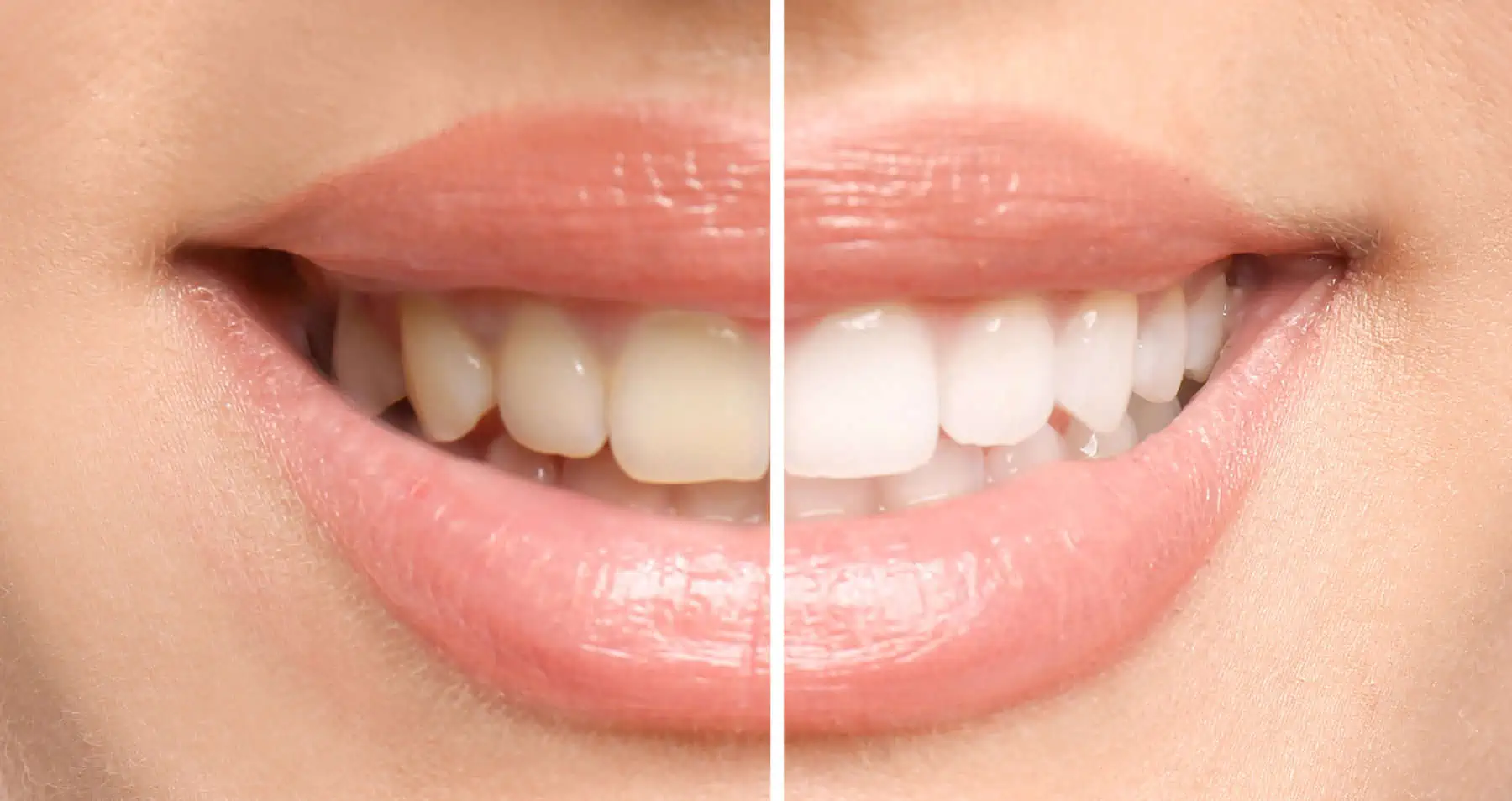 Teeth Whitening in Irvine CA