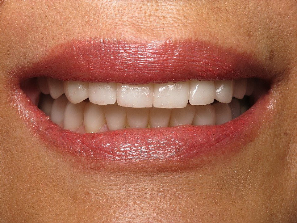 Full mouth reconstruction result in Irvine CA