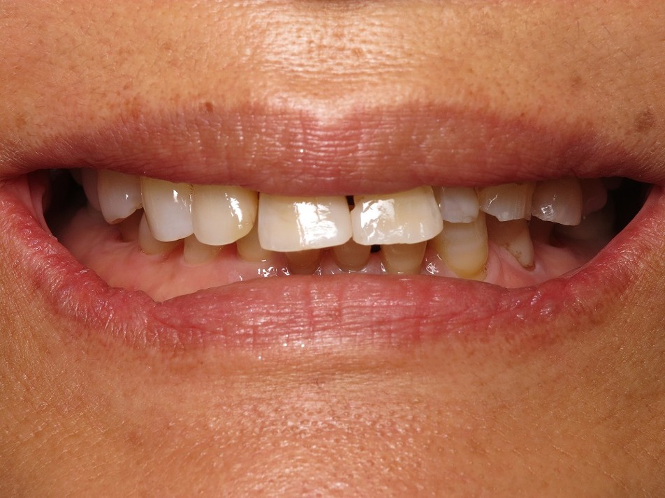 Full Mouth Reconstruction Case 1 Before