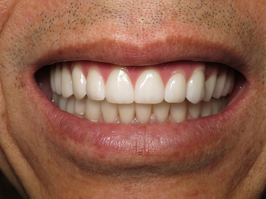 Comprehensive Smile Makeover Case 2 After