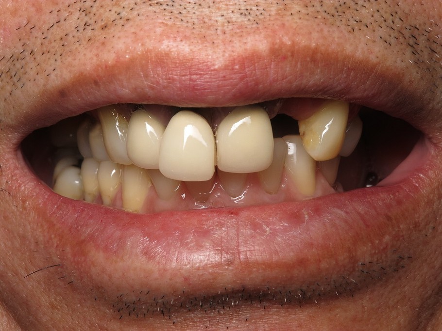 Comprehensive Smile Makeover Case 2 Before