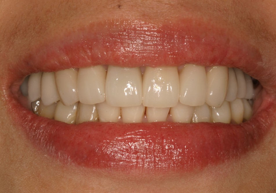 Smile Makeover Case 3 After