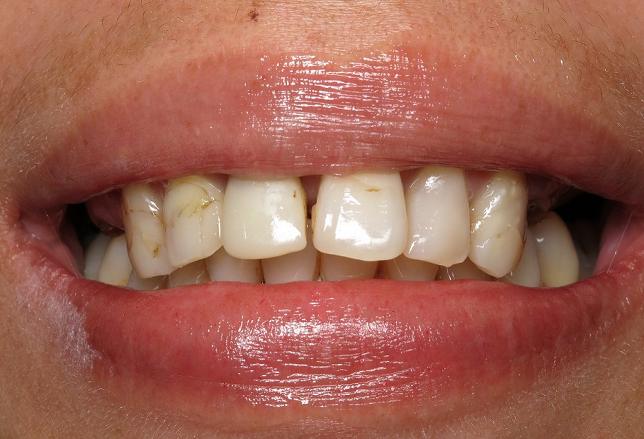 Smile Makeover Case 3 Before