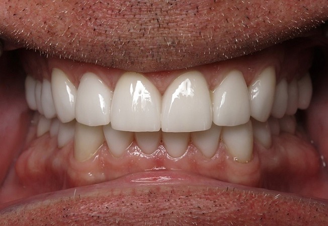 Full Arch Reconstruction Case 4 After