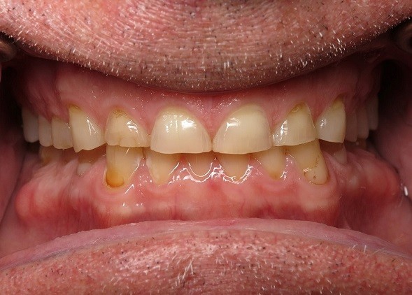 Full Arch Reconstruction Case 4 Before