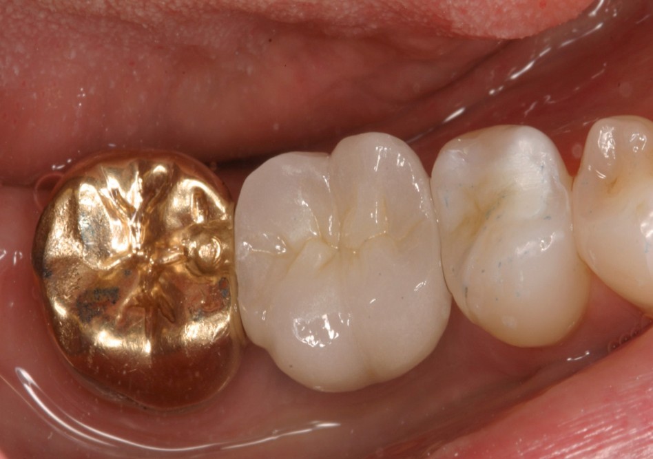 Implant-based tooth restoration result in Irvine CA