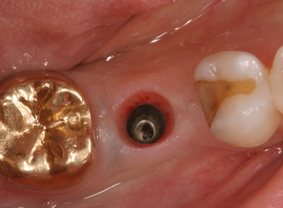 Dental Implant Case 1 Before