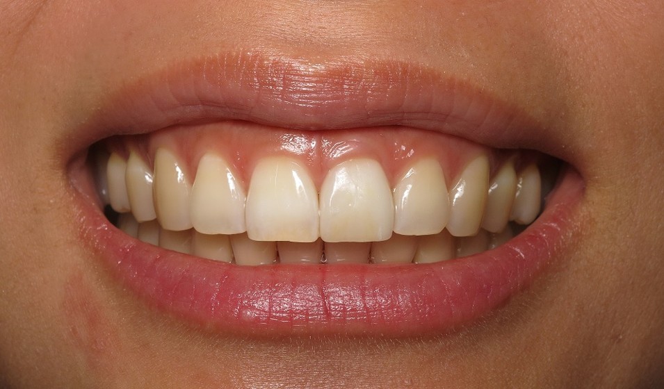Dental Implant Case 2 After