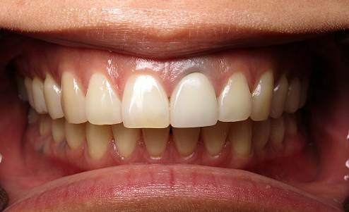 Dental Implant Case 2 Before