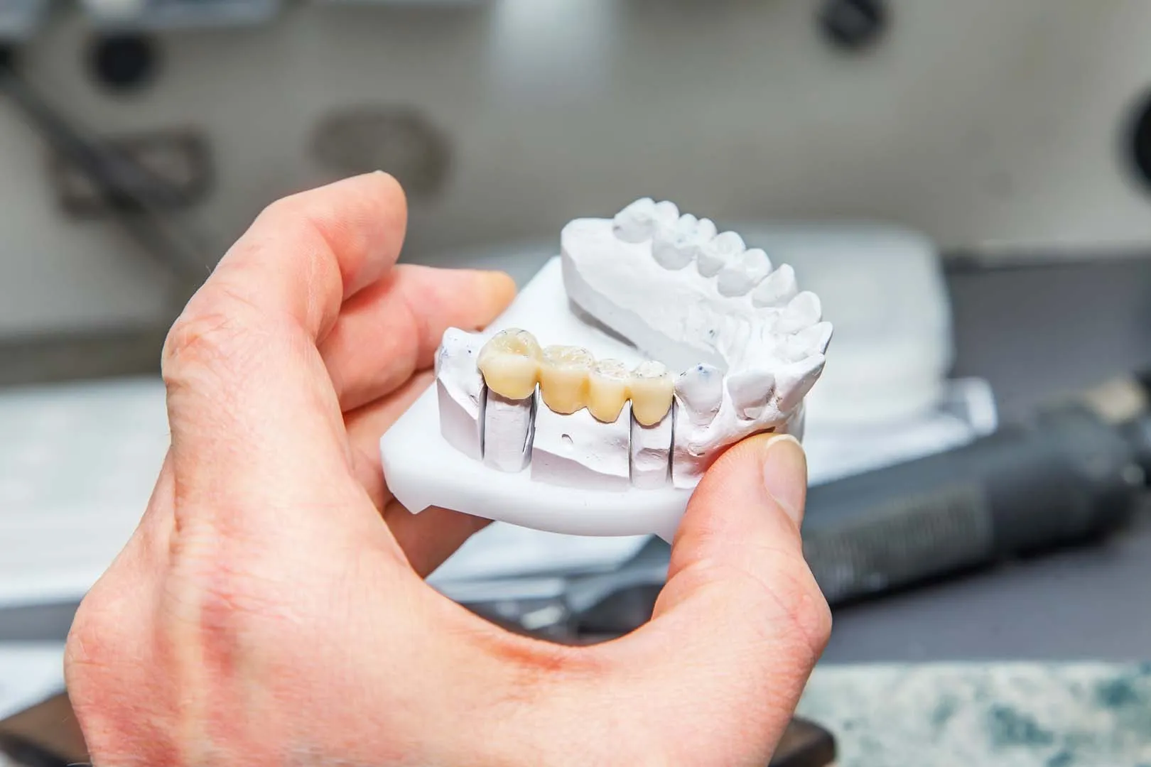 Your Bridge Consultation and Treatment Plan — Dental Bridges in Irvine, CA