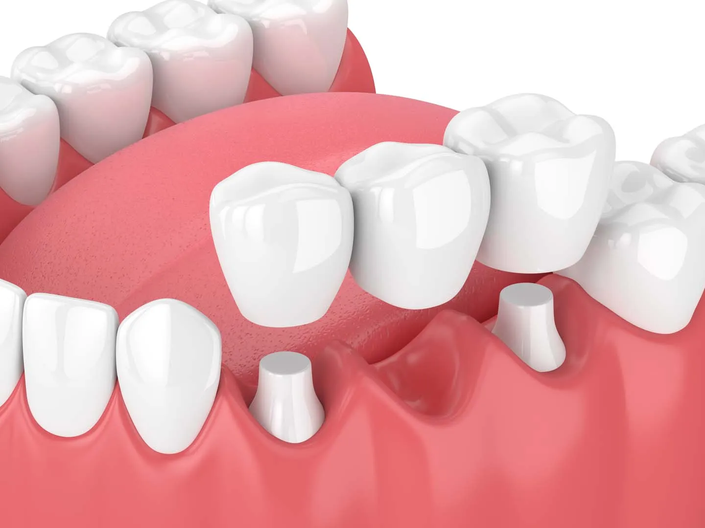 The Bridge Placement Process, Step by Step — Dental Bridges in Irvine, CA