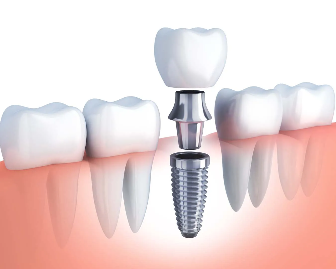 Consultation and 3D CT Imaging — Dental Implants in Irvine, CA