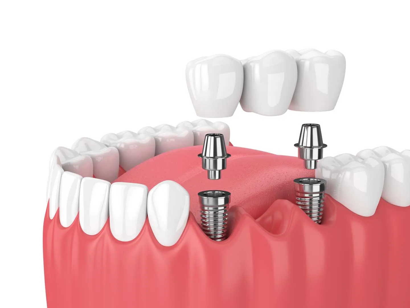 Crown Placement and Final Restoration — Dental Implants in Irvine, CA