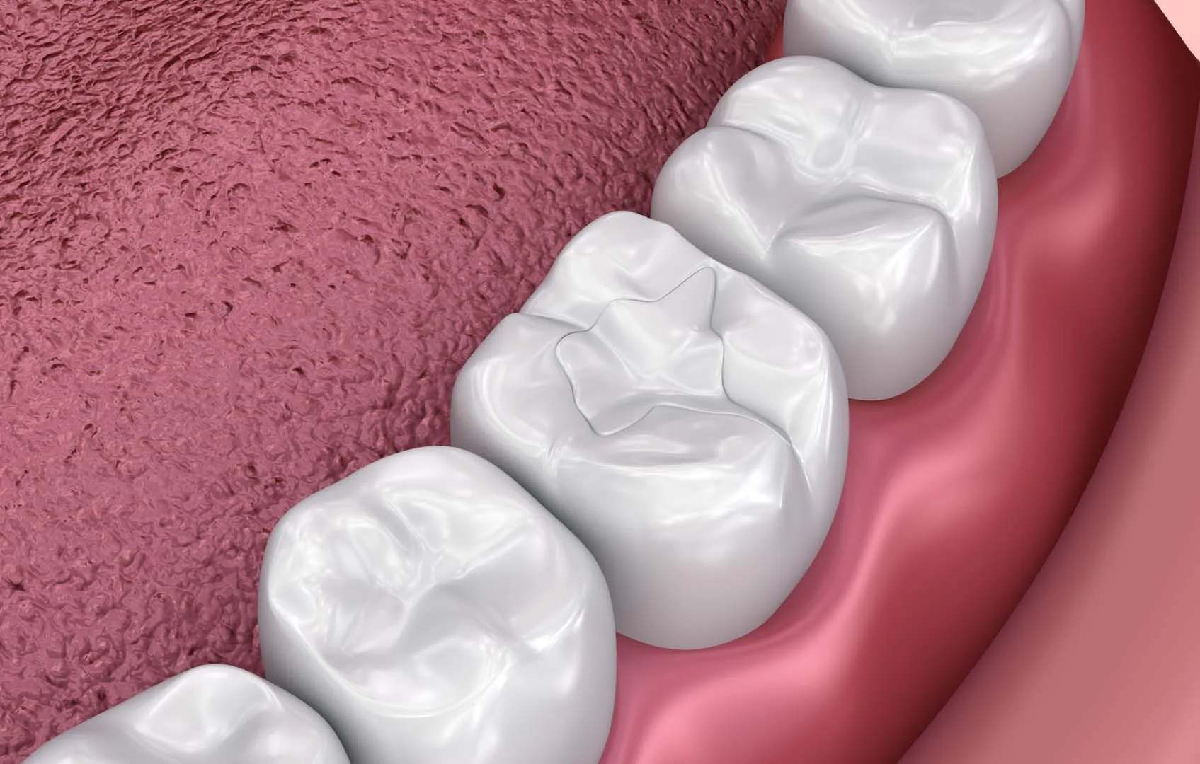 Aftercare and How Long Results Last — Icon Resin Treatments in Irvine, CA