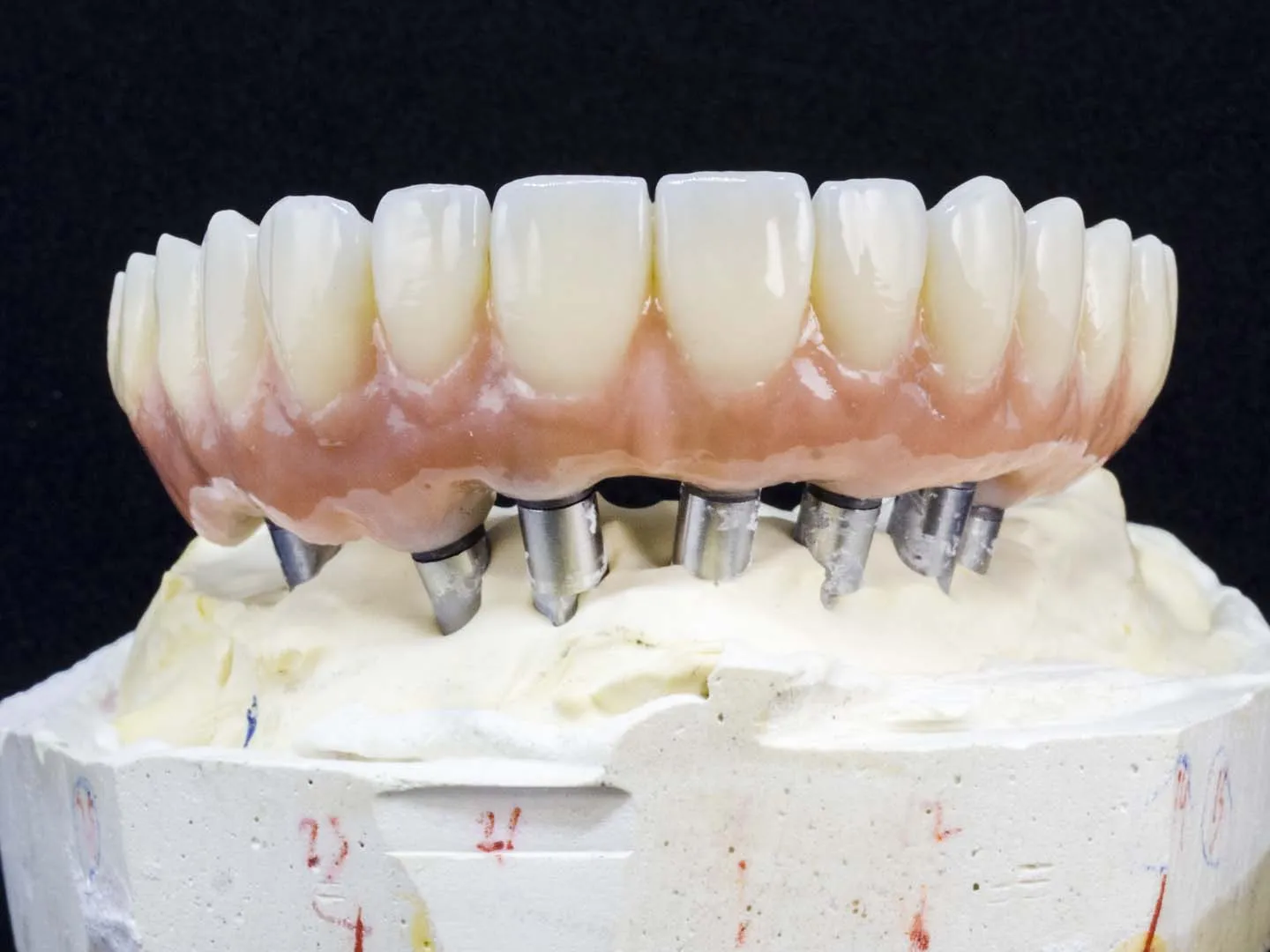 Consultation and 3D Imaging — Implant-Supported Dentures in Irvine, CA