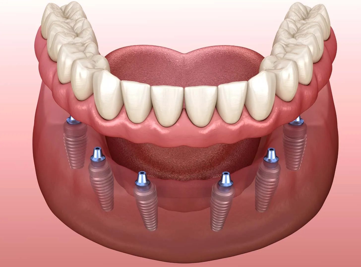 Implant Placement and Healing — Implant-Supported Dentures in Irvine, CA