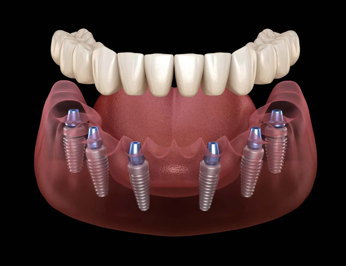 Attaching Your Custom Denture — Implant-Supported Dentures in Irvine, CA