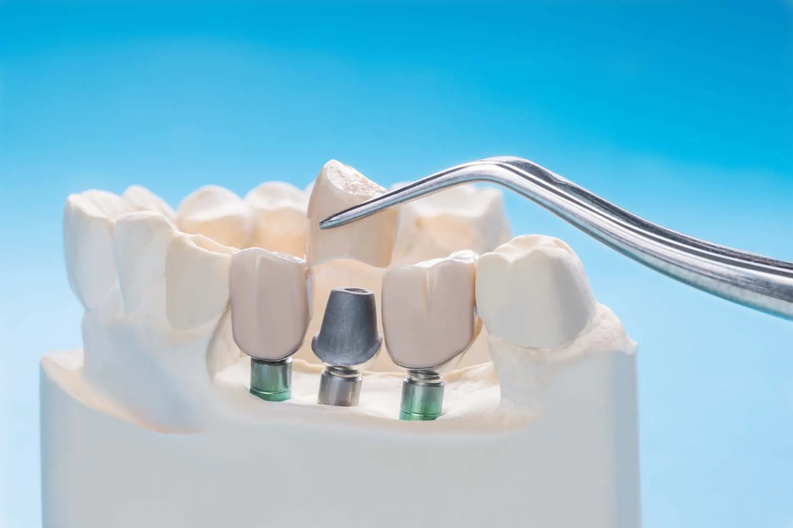 Implant Placement and Healing — Implant Overdentures in Irvine, CA