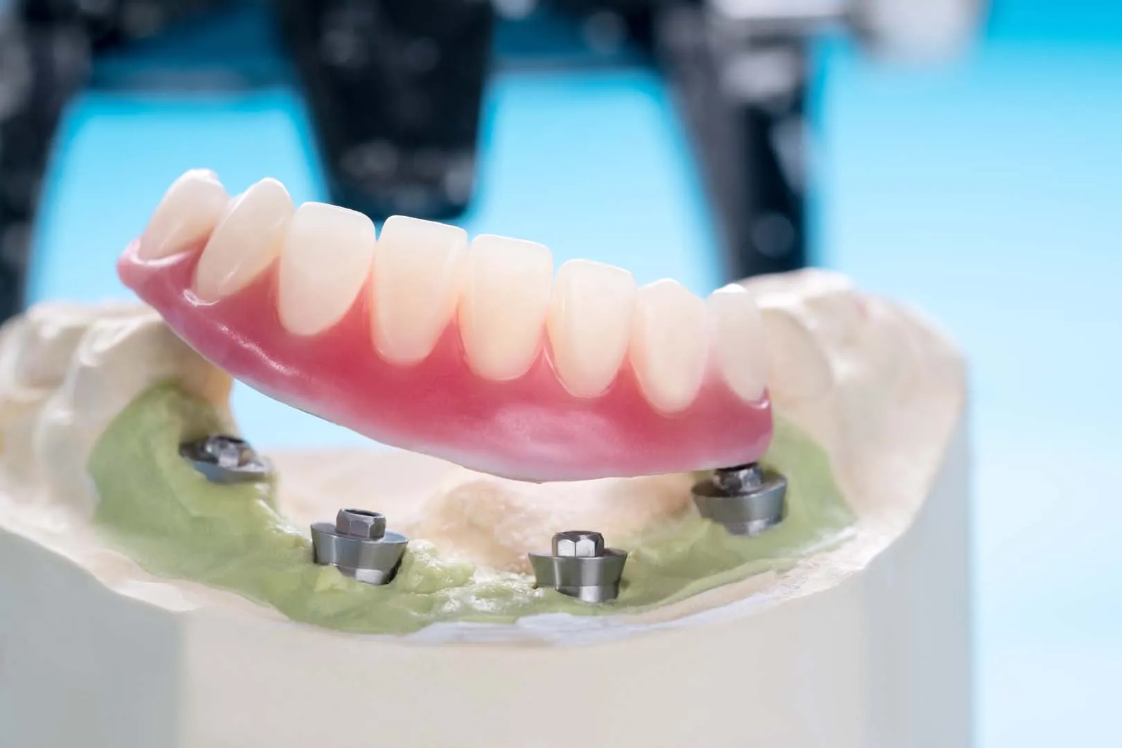 Fitting Your Custom Overdenture and Follow-Up Care — Implant Overdentures in Irvine, CA