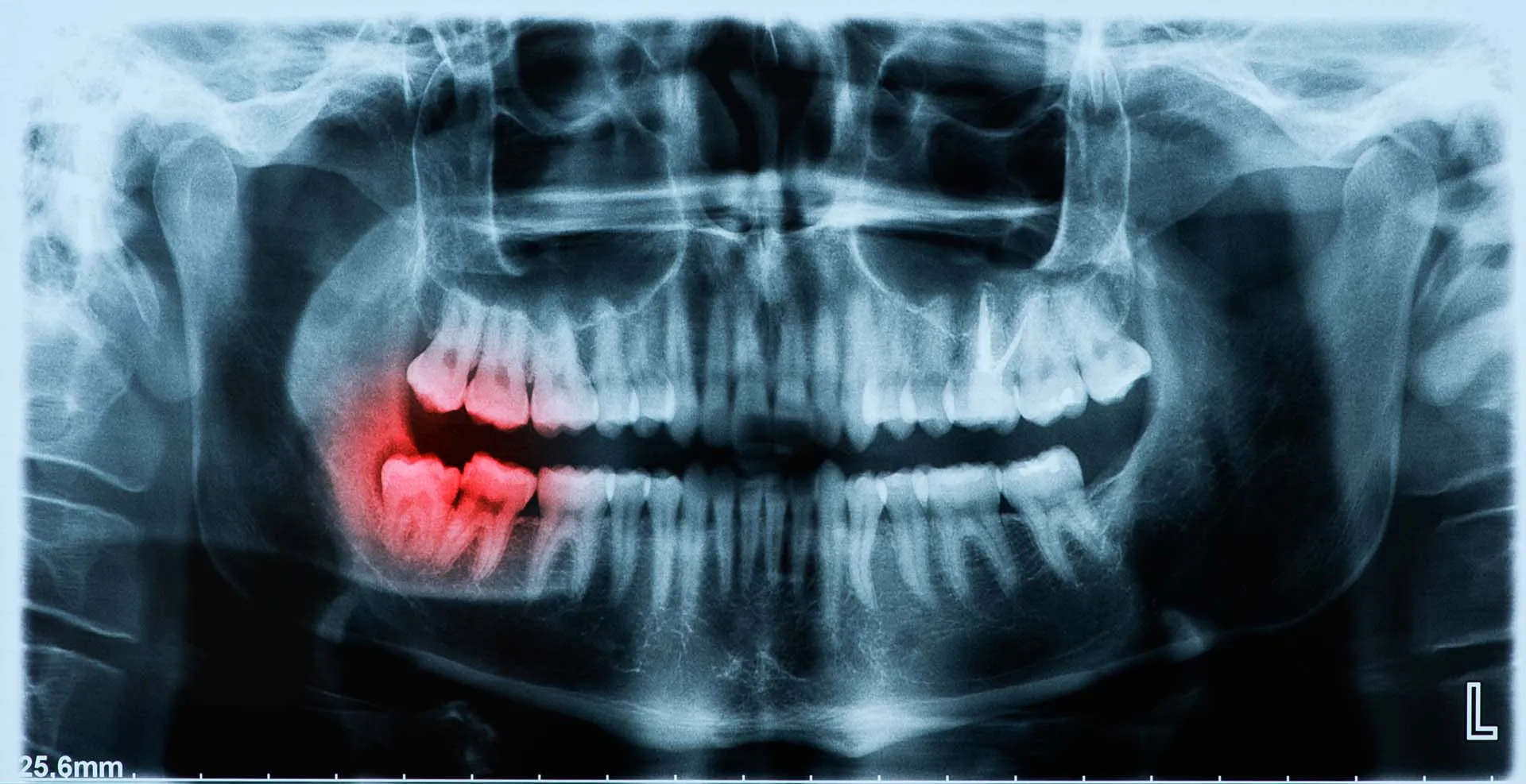 Recovery and Aftercare Guidance — Oral Surgery in Irvine, CA