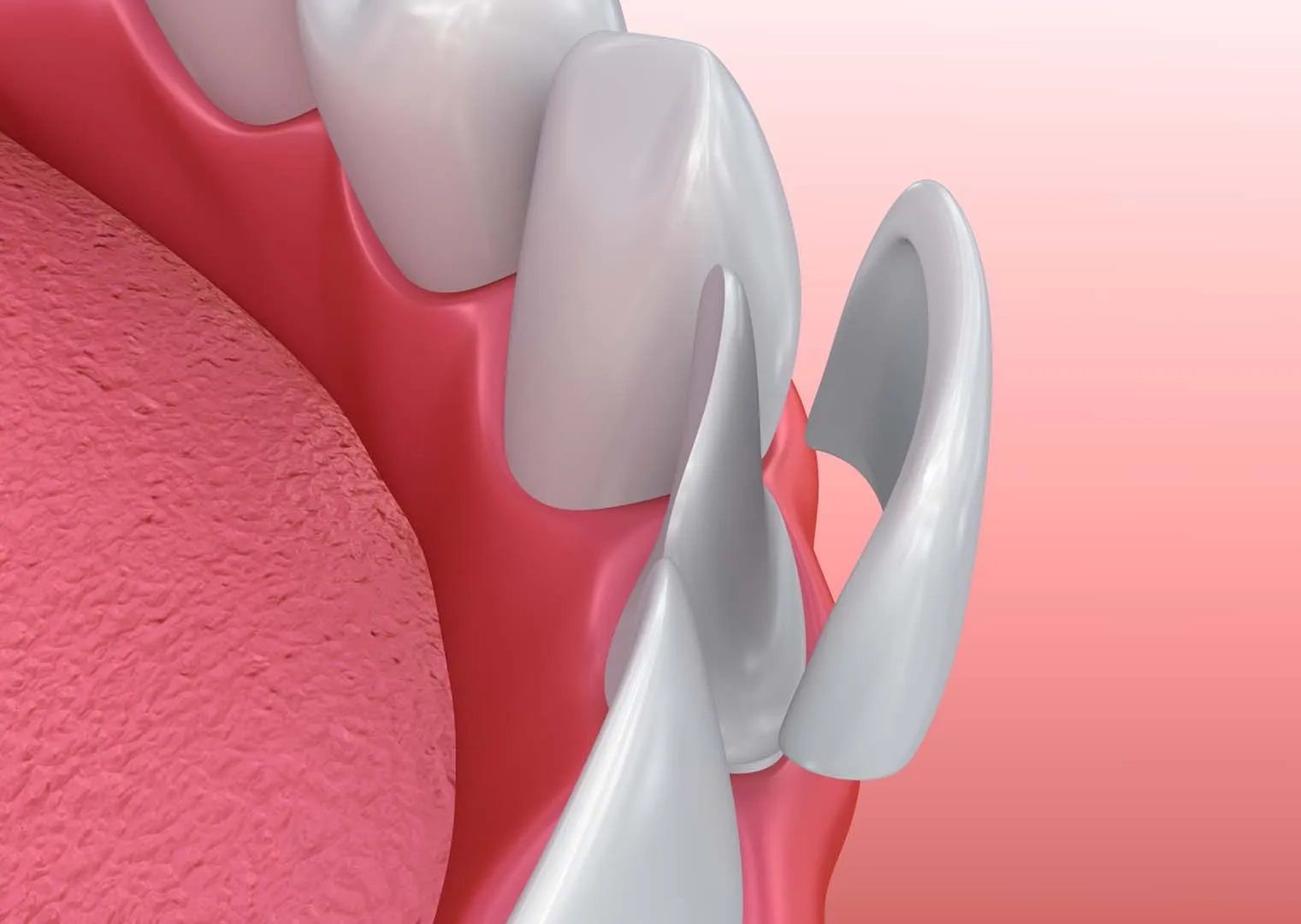 Preparation, Design, and Placement — Porcelain Veneers in Irvine, CA