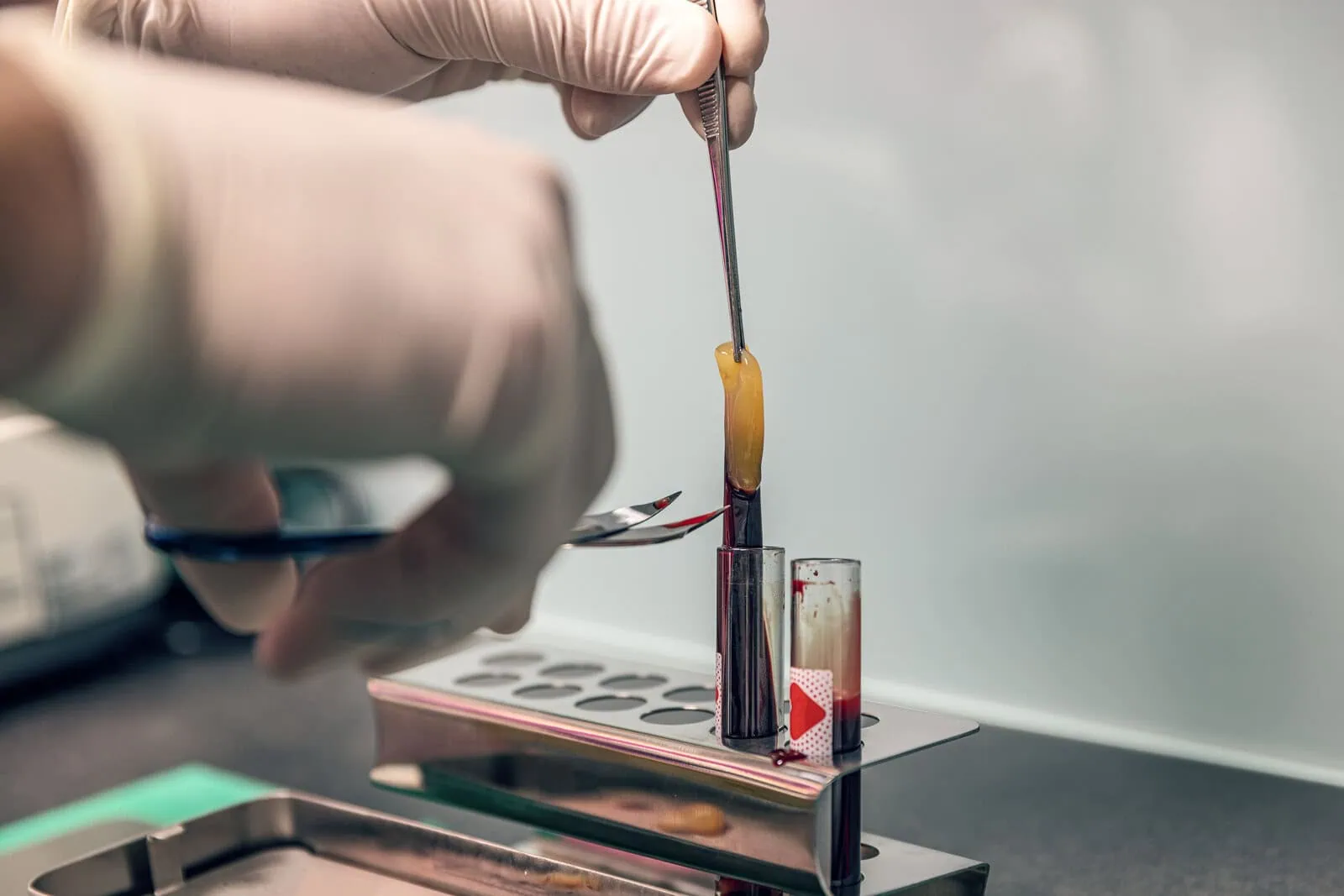Step-by-Step: From Blood Draw to Application — PRP in Irvine, CA