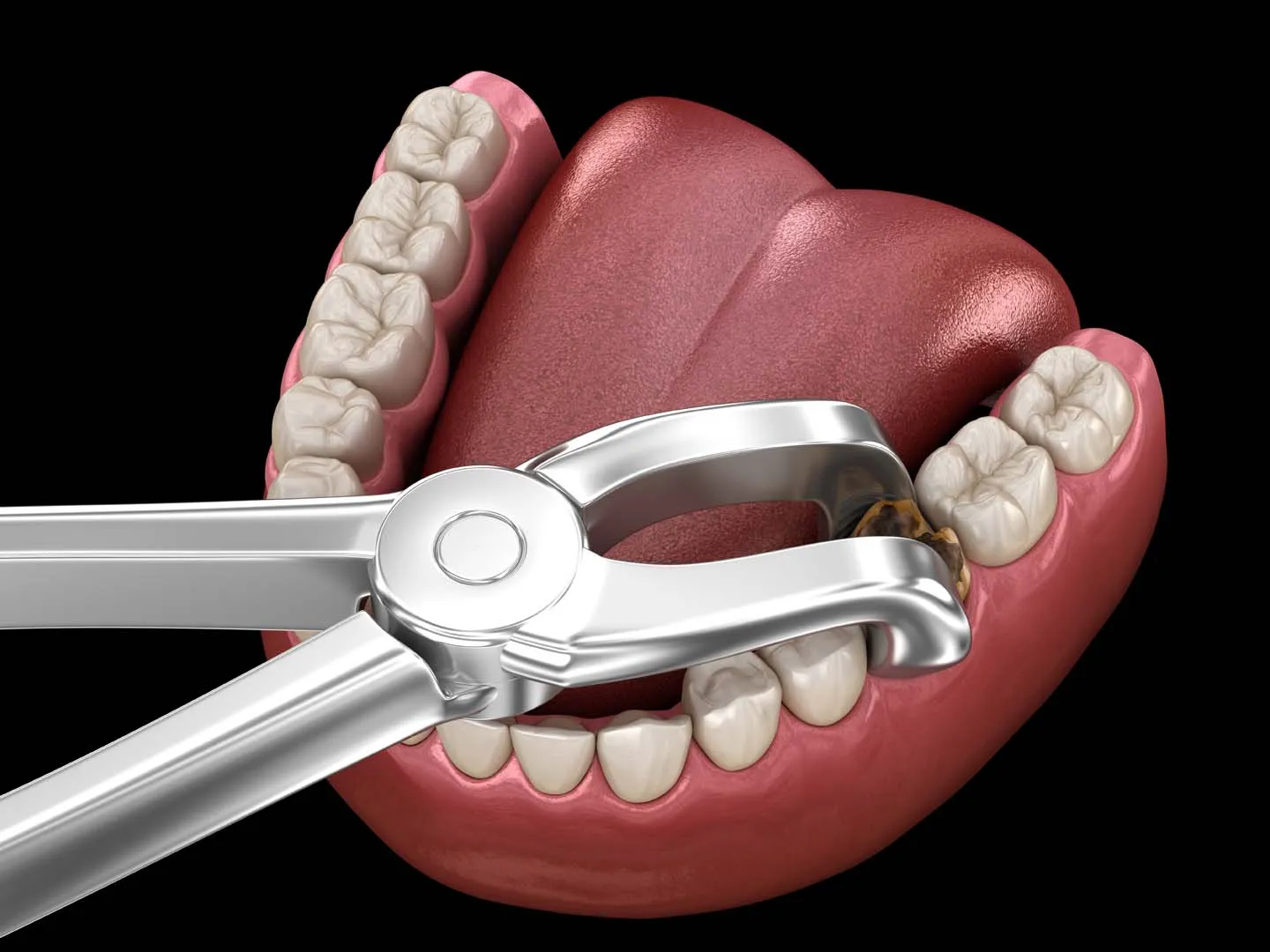 During the Procedure: Step-by-Step — Tooth Extractions in Irvine, CA