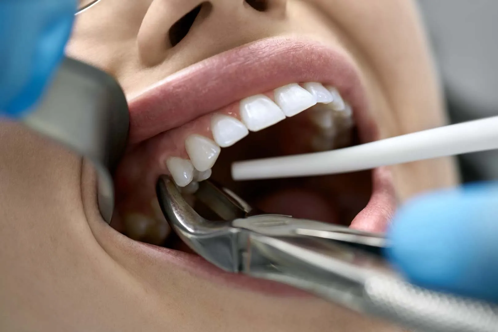 After Your Extraction: Recovery and Next Steps — Tooth Extractions in Irvine, CA