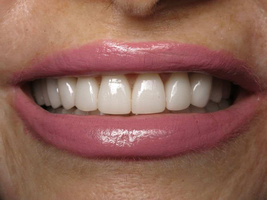 Porcelain Veneers After Transformation