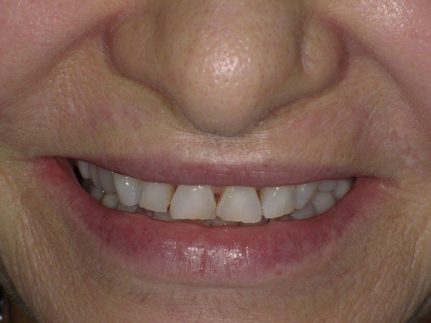 Porcelain Veneers Before Treatment