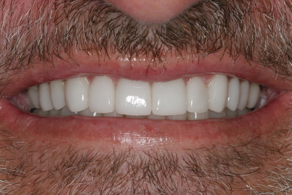 Porcelain Veneers Case 2 After