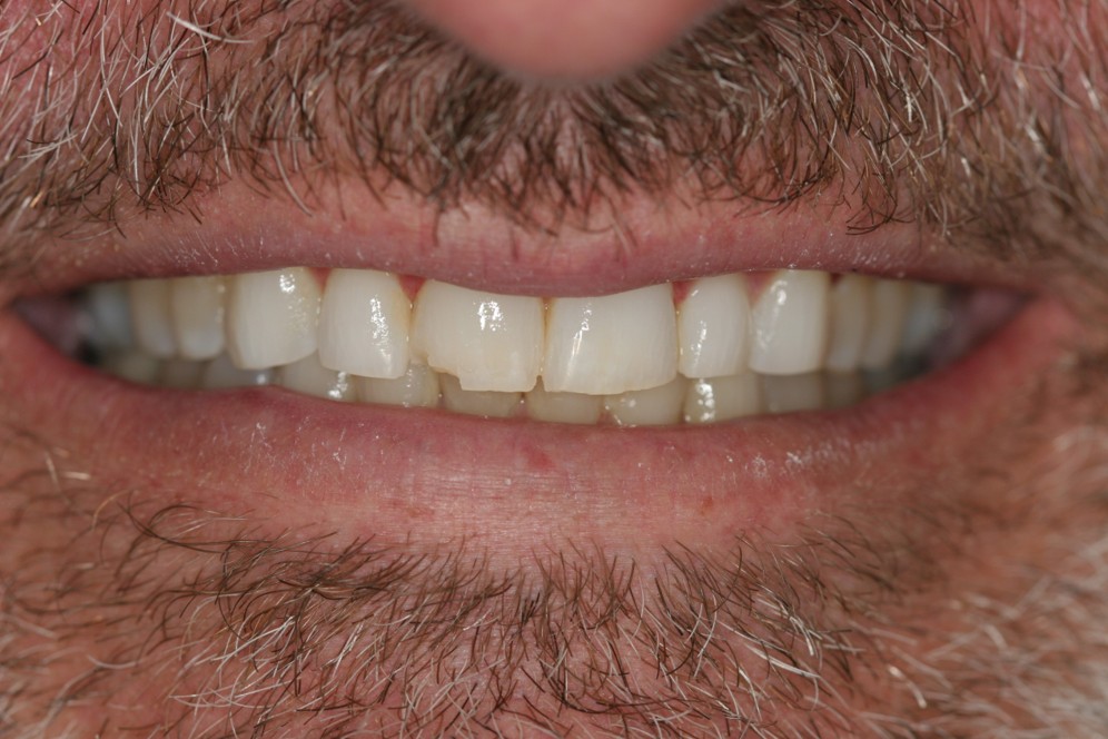 Porcelain Veneers Case 2 Before