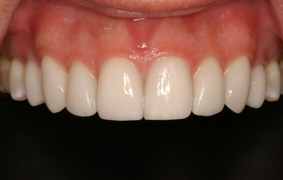 Porcelain Veneers Case 3 After