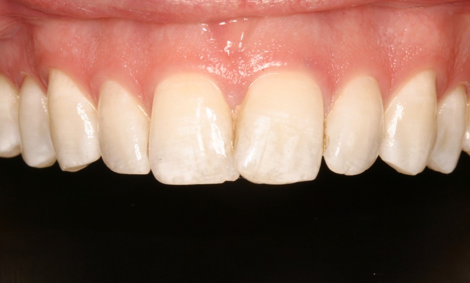 Porcelain Veneers Case 3 Before