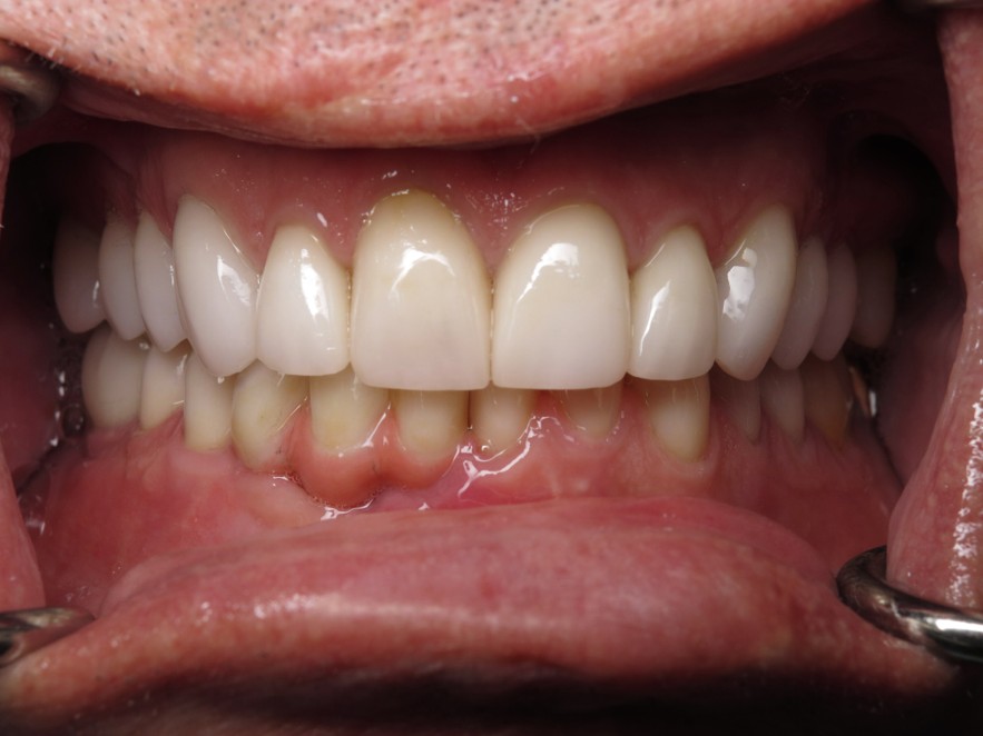 Veneer and Implant Combination Case After