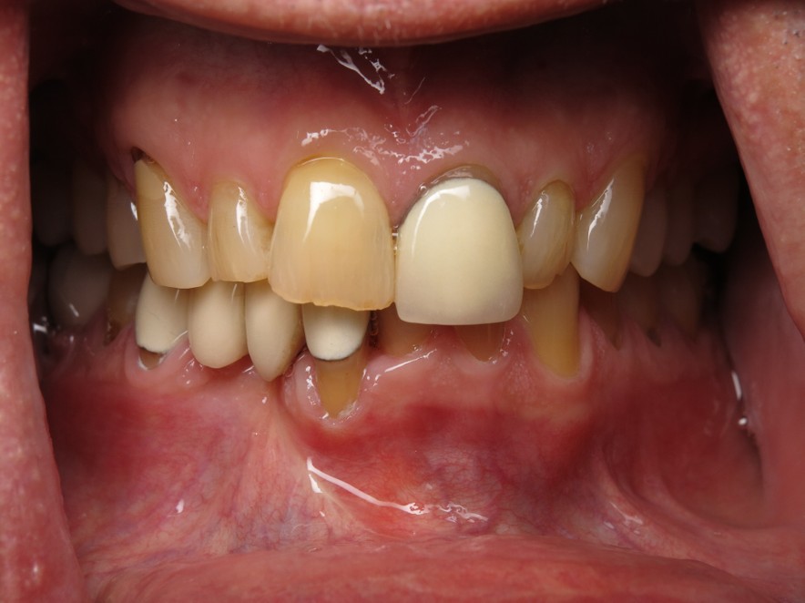 Veneer and Implant Combination Case Before