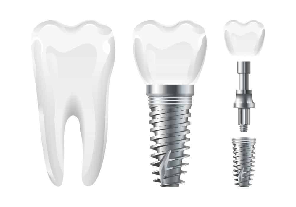 Dental Implants: Why Your Jawbone Needs Them 65772188ca42f.jpeg
