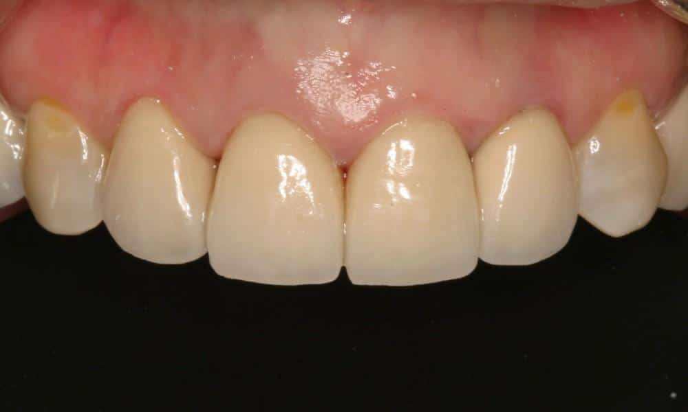 Tips to Prevent Staining Your Veneers 657721419c6cc.jpeg