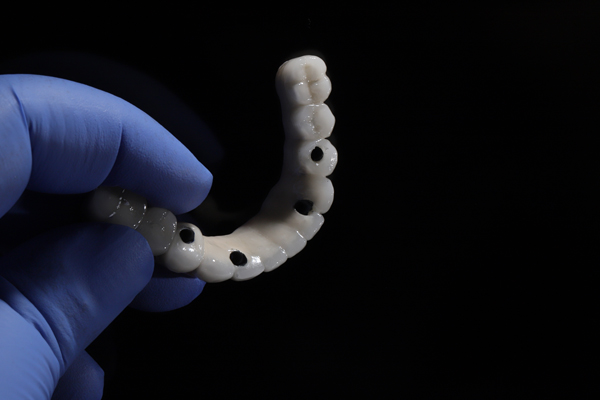 Behind The Scenes: What Dentists Want You To Know About Placing All On X Implants