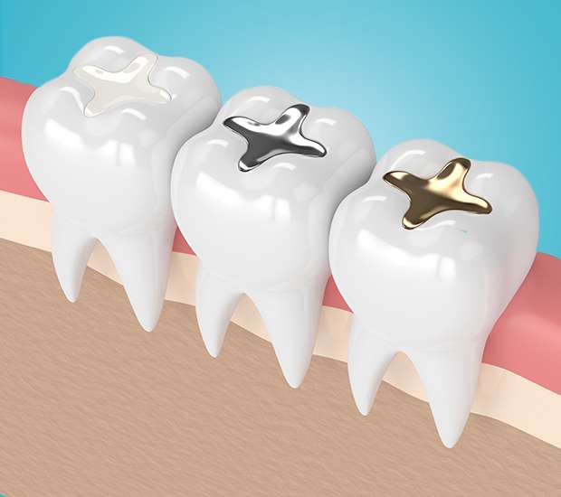 Irvine Tooth Colored Fillings