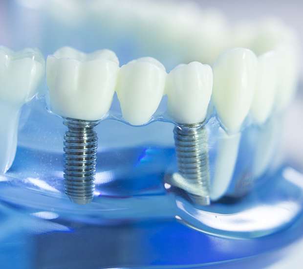 Irvine Dental Prosthetics