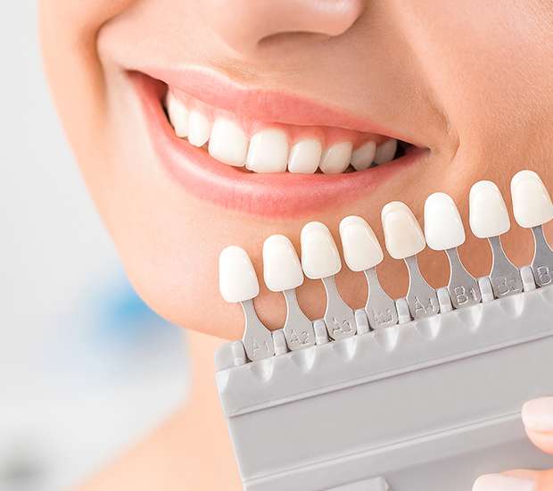 Irvine Veneers